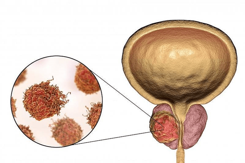 hogyan néz ki a prosztata károsodása