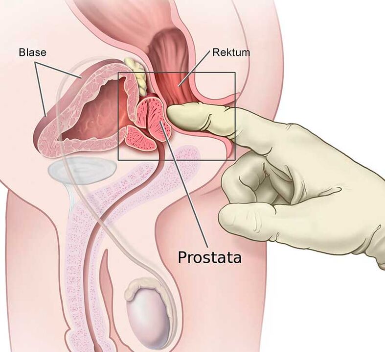 prosztata masszázs prosztatagyulladás esetén